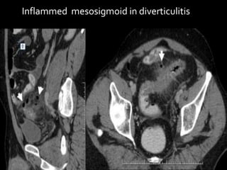 Inflammed mesosigmoid in diverticulitis
 