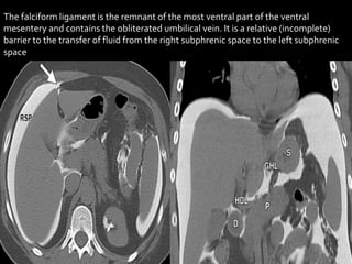 The falciform ligament is the remnant of the most ventral part of the ventral
mesentery and contains the obliterated umbilical vein. It is a relative (incomplete)
barrier to the transfer of fluid from the right subphrenic space to the left subphrenic
space
 