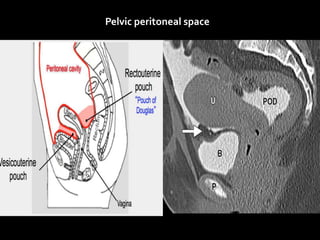Pelvic peritoneal space
 