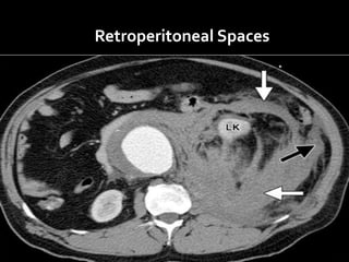 Retroperitoneal Spaces
 