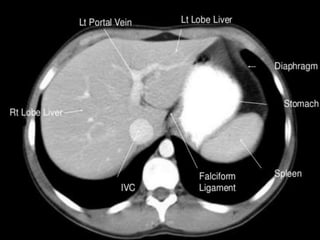 Ct abdominal ………………………………………………………...pdf