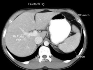 Ct abdominal ………………………………………………………...pdf