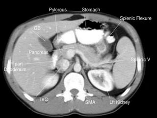 Ct abdominal ………………………………………………………...pdf