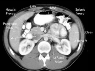 Ct abdominal ………………………………………………………...pdf