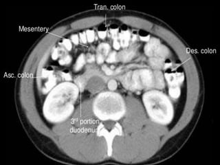 Ct abdominal ………………………………………………………...pdf