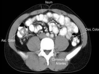 Ct abdominal ………………………………………………………...pdf