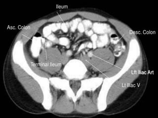 Ct abdominal ………………………………………………………...pdf