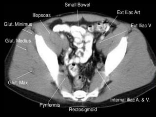 Ct abdominal ………………………………………………………...pdf