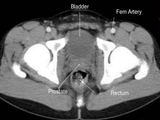 Ct abdominal ………………………………………………………...pdf