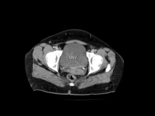 Ct abdominal ………………………………………………………...pdf