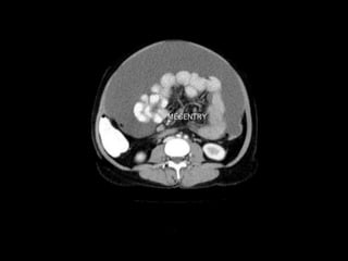 Ct abdominal ………………………………………………………...pdf