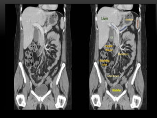 Ct abdominal ………………………………………………………...pdf