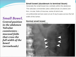 Small Bowel.
Central position
in the abdomen
Valvulae
conniventes -
mucosal folds
that cross the
full width of the
bowel
(arrowheads)
 