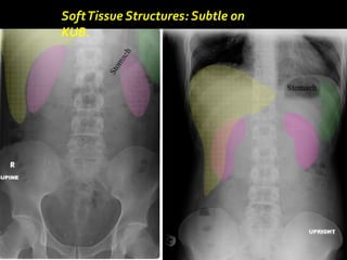 SoftTissue Structures: Subtle on
KUB.
 