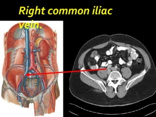 Right common iliac
vein.
 