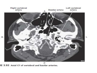 CT Angiography Head and Neck | PPTX