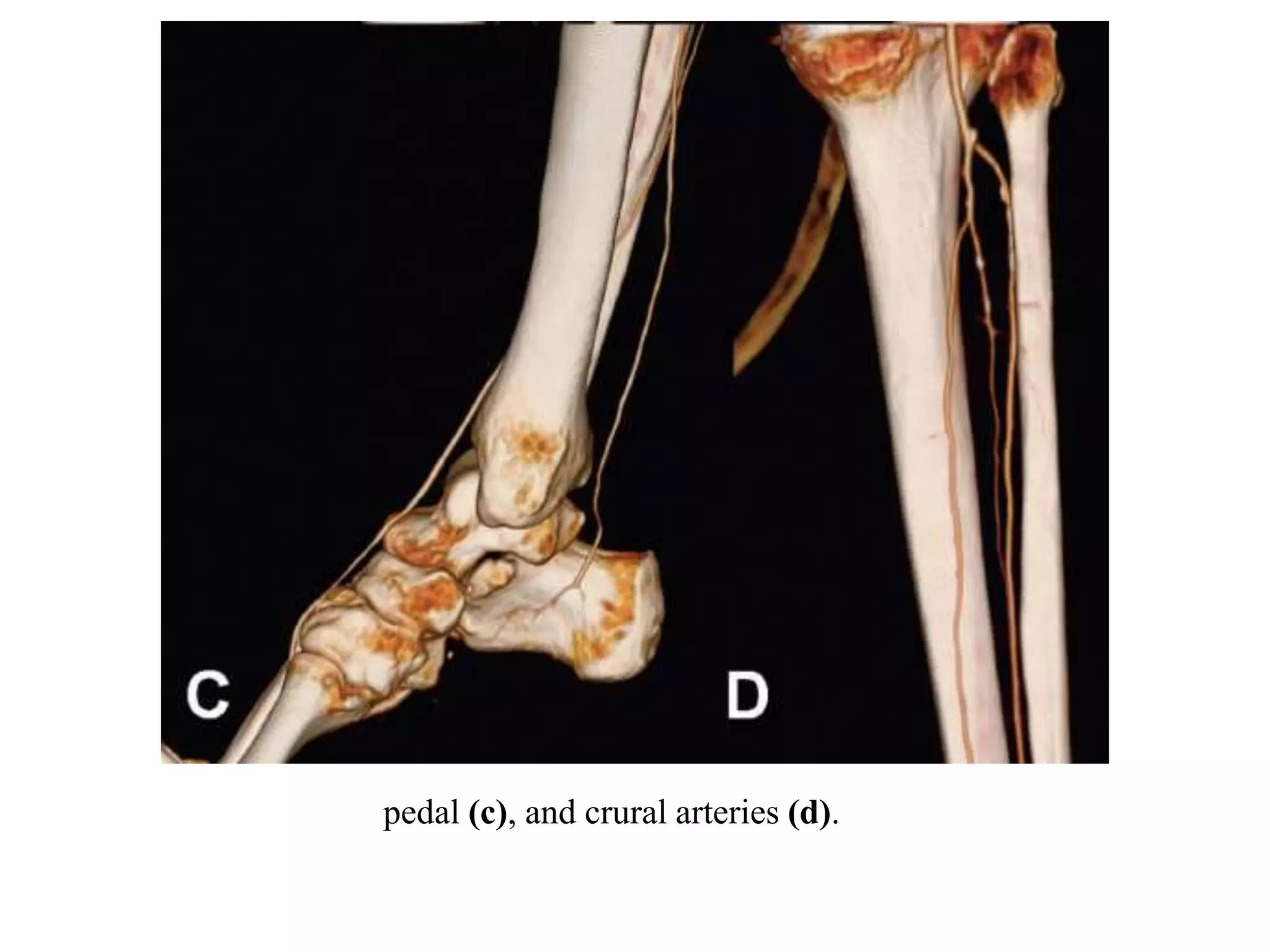 CT Angiography Lower Limb | PPTX