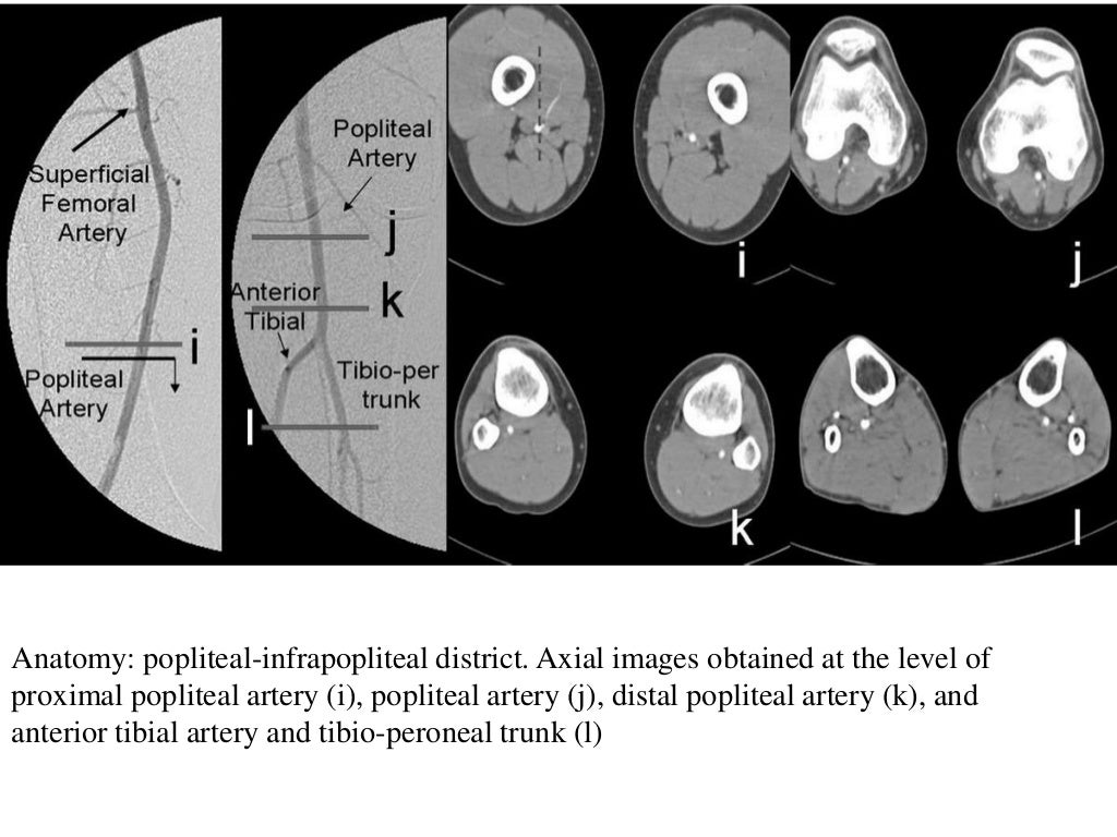CT Angiography Lower Limb