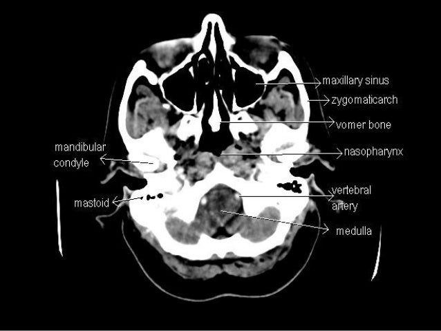 Head ct scan interpretation ppt presentation