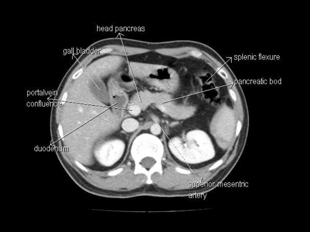 Ct Scan Labeled