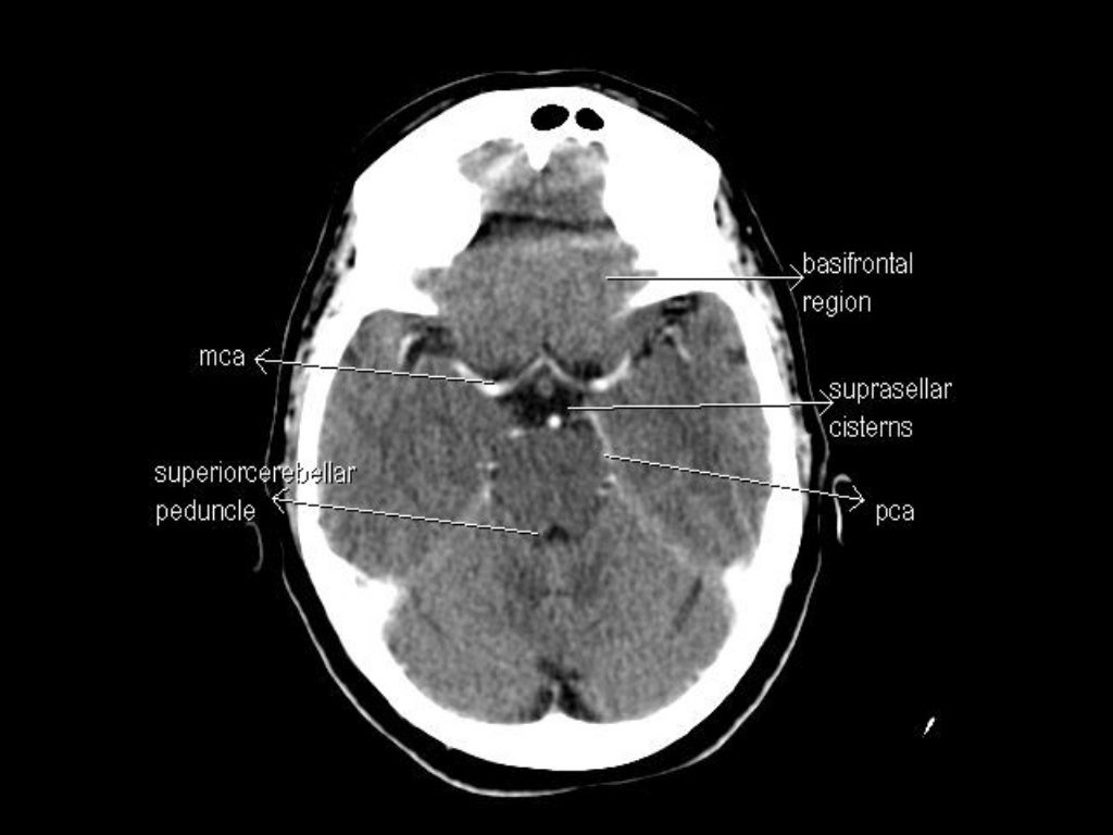 CT Anatomy