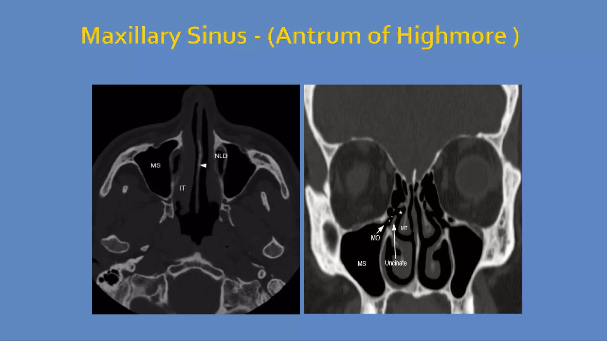 Ct anatomy of paranasal sinuses( PNS) pk.pdf ppt PPT