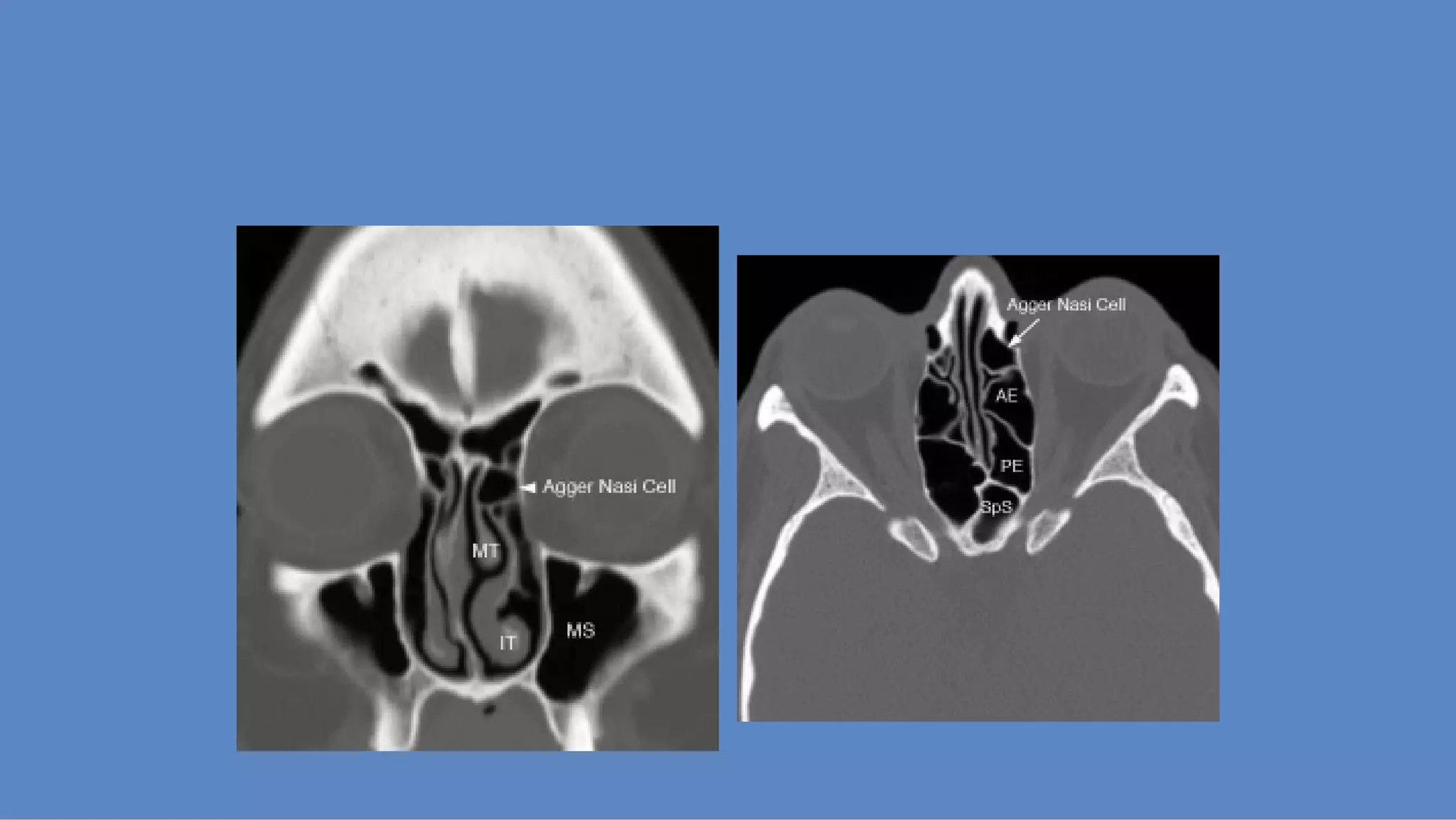 Ct anatomy of paranasal sinuses( PNS) pk.pdf ppt PPT