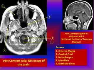 Post Contrast Axial MR Image of
the brain
1
2
3
4
5
Post Contrast sagittal T1
Weighted M.R.I.
Section at the level of Foramen
Magnum
Answers
1. Cisterna Magna
2. Cervical Cord
3. Nasopharynx
4. Mandible
5. Maxillary Sinus
 