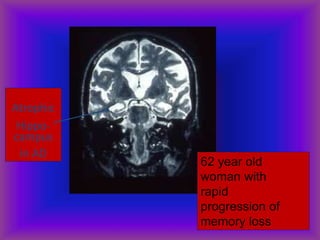 Atrophic
Hippo-
campus
in AD
62 year old
woman with
rapid
progression of
memory loss
 