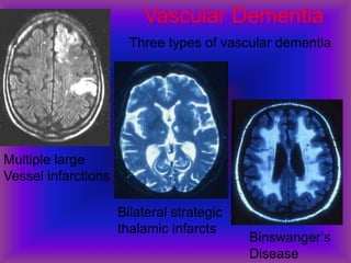 Vascular Dementia
Three types of vascular dementia
Multiple large
Vessel infarctions
Bilateral strategic
thalamic infarcts
Binswanger’s
Disease
 