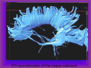DTI reconstruction of the corpus callosum
 