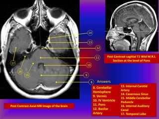 Post Contrast Axial MR Image of the brain
15
8
9
10
11
12
13
14
16
17
Post Contrast sagittal T1 Wtd M.R.I.
Section at the level of Pons
Answers
8. Cerebellar
Hemisphere
9. Vermis
10. IV Ventricle
11. Pons
12. Basilar
Artery
13. Internal Carotid
Artery
14. Cavernous Sinus
15. Middle Cerebellar
Peduncle
16. Internal Auditory
Canal
17. Temporal Lobe
 