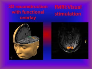 3D reconstruction
with functional
overlay
fMRI:Visual
stimulation
 