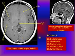 Post Contrast Axial MR Image of the brain
23
24
25
26
27
Post Contrast sagittal T1 Wtd M.R.I.
Section at the level of the
III Ventricle
Answers
23. Occipital Lobe
24. III Ventricle
25. Frontal Lobe
26. Temporal Lobe
27. Sylvian Fissure
 