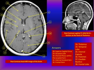 Post Contrast Axial MR Image of the brain
28
29
30
31
32
38
33
34
36
35
37
Post Contrast sagittal T1 Wtd M.R.I.
Section at the level of Thalamus
Answers
28. Superior Sagittal Sinus
29. Occipital Lobe
30. Choroid Plexus within
the occipital horn
31. Internal Cerebral Vein
32. Frontal Horn
33. Thalamus
34. Temporal
Lobe
35. Internal
Capsule
36. Putamen
37. Caudate
Nucleus
38. Frontal Lobe
 
