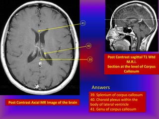 Post Contrast Axial MR Image of the brain
39
40
41
Post Contrast sagittal T1 Wtd
M.R.I.
Section at the level of Corpus
Callosum
Answers
39. Splenium of corpus callosum
40. Choroid plexus within the
body of lateral ventricle
41. Genu of corpus callosum
 