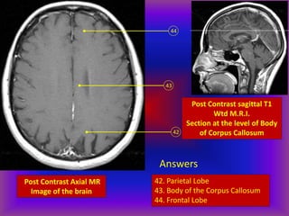 Post Contrast Axial MR
Image of the brain
42
43
44
Post Contrast sagittal T1
Wtd M.R.I.
Section at the level of Body
of Corpus Callosum
Answers
42. Parietal Lobe
43. Body of the Corpus Callosum
44. Frontal Lobe
 