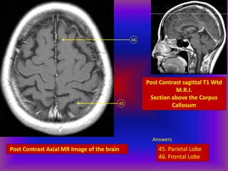 Post Contrast Axial MR Image of the brain
45
46
Post Contrast sagittal T1 Wtd
M.R.I.
Section above the Corpus
Callosum
Answers
45. Parietal Lobe
46. Frontal Lobe
 