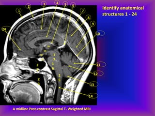 1
A midline Post-contrast Sagittal T1 Weighted MRI
2
3 4 5 6
7
8
9
10
11
12
13
14
1
6
1
5
1
7
18
19
20
21
2
2
2
3
24
Identify anatomical
structures 1 - 24
 