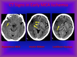 CT Signs in Early MCA Ischemia
Hyperdense MCA Insular Ribbon Lentiform Nucleus
 