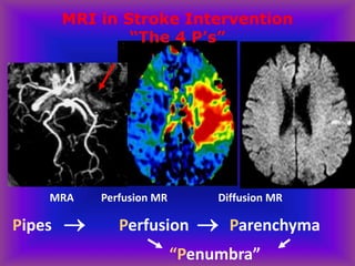 Pipes  Perfusion  Parenchyma
MRA Perfusion MR Diffusion MR
“Penumbra”
MRI in Stroke Intervention
“The 4 P’s”
 