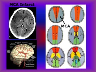 MCA Infarct
MCA
 