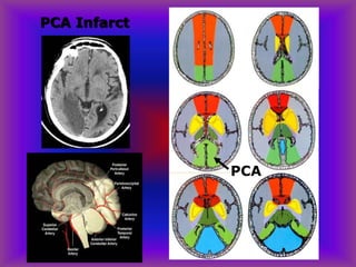 PCA Infarct
PCA
 