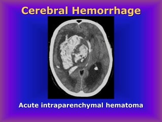 Acute intraparenchymal hematoma
Cerebral Hemorrhage
 