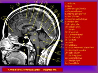 1
A midline Post-contrast Sagittal T1 Weighted MRI
2
3 4 5 6
7
8
9
10
11
12
13
14
16
15
17
18
19
20
21
2
2
2
3
24
1. Scalp fat
2. Bone
3. Inferior sagittal sinus
4. Corpus callosum
5. Internal cerebral vein
6. Vein of Galen
7. Superior sagittal sinus
8. Parietal lobe
9. Occipital lobe
10. Straight sinus
11. Vermis
12. IV ventricle
13. Cerebellar tonsil
14. Cervical cord
15. Medulla
16. Pons
17. Midbrain
18. Mass intermedia of thalamus
19. Anterior III ventricle
20. Optic chiasm
21. Pituitary gland
22. Sphenoid sinus
23. Nasopharynx
24. Frontal lobe
 