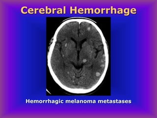 Hemorrhagic melanoma metastases
Cerebral Hemorrhage
 