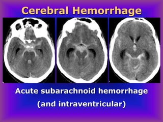 Acute subarachnoid hemorrhage
(and intraventricular)
Cerebral Hemorrhage
 