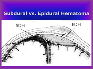 Subdural vs. Epidural Hematoma
 