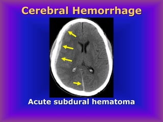 Acute subdural hematoma
Cerebral Hemorrhage
 