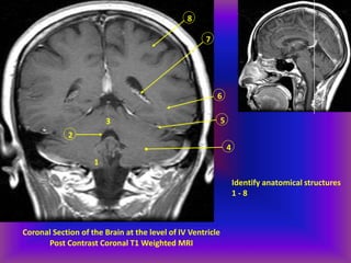 Coronal Section of the Brain at the level of IV Ventricle
Post Contrast Coronal T1 Weighted MRI
8
7
6
5
4
3
2
1
Identify anatomical structures
1 - 8
 